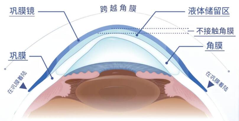 北京首例！国内首批四区设计巩膜镜在茗视光眼科由近视大医生周跃华成功验配